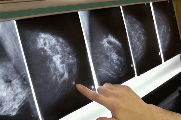تشخیص صحیح سرطان سینه با هوش مصنوعی